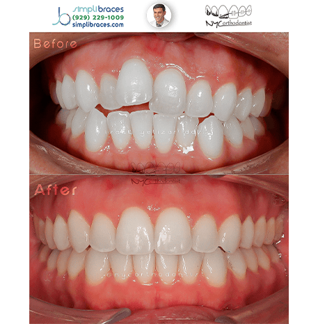 Smile before and after orthodontic treatment for crooked and protruding teeth