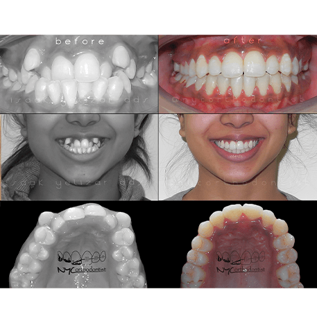 Smile before and after treatment to align crooked teeth