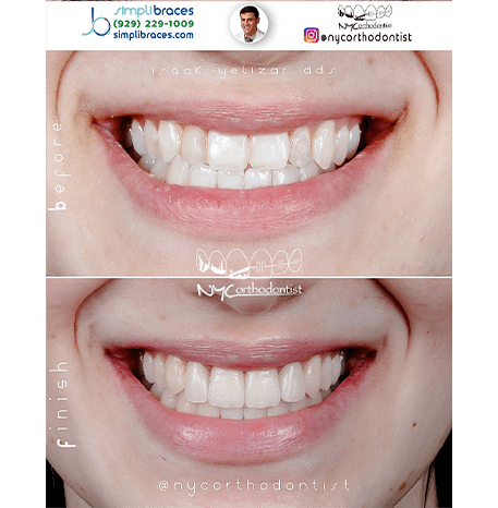 Close up of smile before and after orthodontic treatment in Queens
