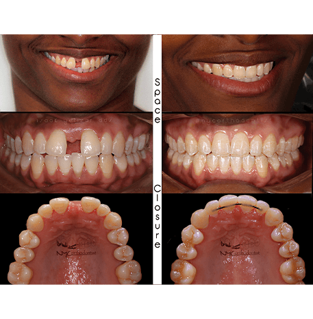 Smile before and after treatment from Queens orthodontist