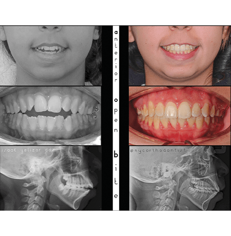 Smile before and after orthodontic treatment for an open bite