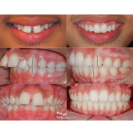 Smile before and after orthodontic treatment for protruding front teeth
