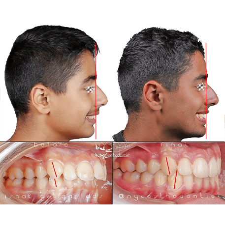 Smile before and after orthodontic treatment for crossbite