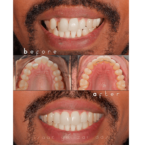 Smile before and after orthodontic treatment for crooked and overlapping teeth