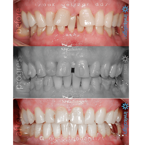 Smile before and after orthodontic treatment to close large gaps between teeth