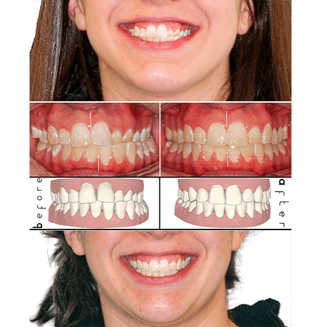 Smile before and after orthodontic correction of crossbite