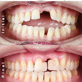 Close up of misaligned teeth before and after treatment from orthodontist in Queens