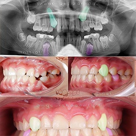 Close up of smile before and after treatment for impacted teeth