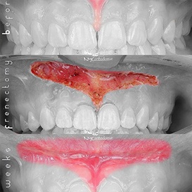 Black and white image of smile before and after treatment from Queens orthodontist