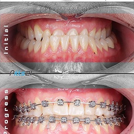 Close up of teeth with and without braces in Queens