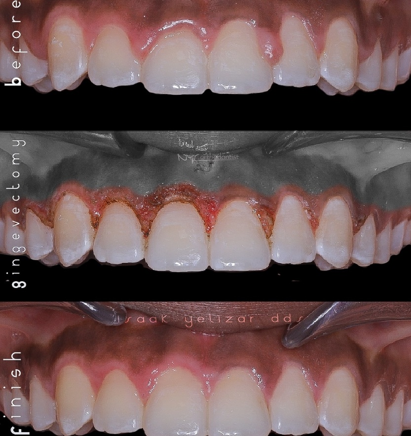 Smile before during and after laser gum recontouring