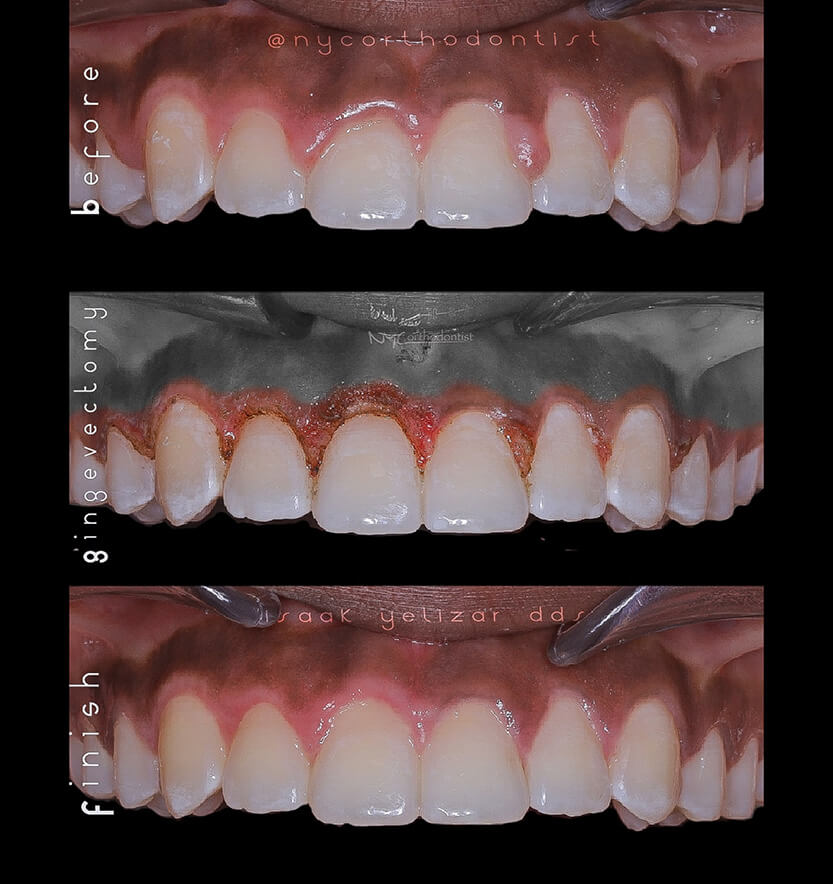 Smile before during and after laser gum recontouring