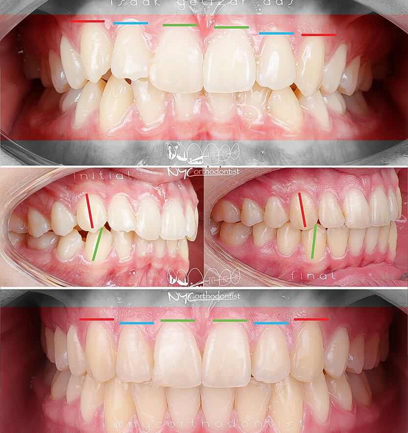 Front and side view of smile before and after laser gum recontouring