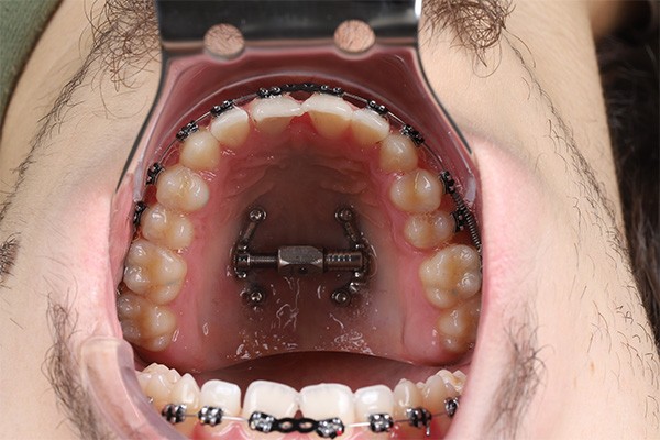 MARPE Miniscrew Example 3: After image