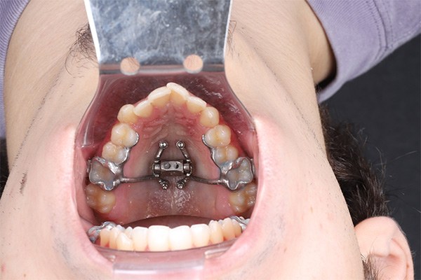 MARPE Miniscrew Example 2: Mid-Process image