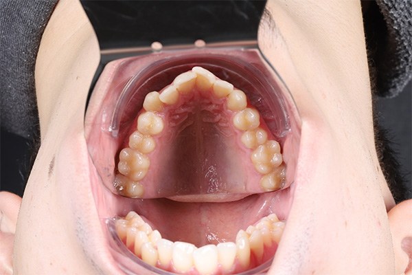 MARPE Miniscrew Example 1: Before image