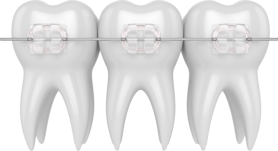 Animated row of teeth with clear and ceramic braces