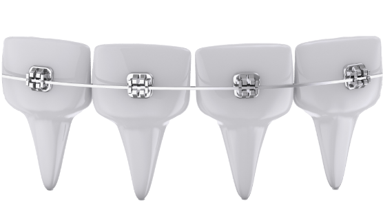 Animated row of teeth with Pitts 21 self ligating braces