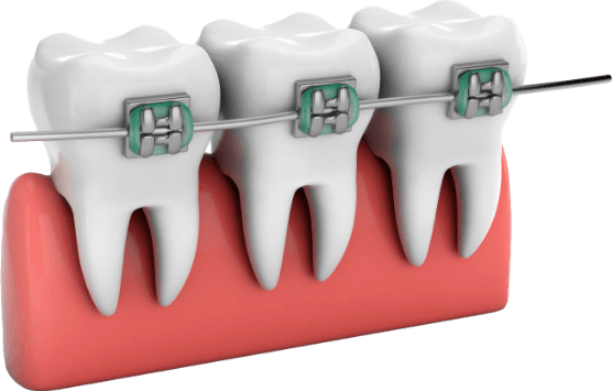 Animated row of teeth with traditional braces