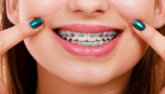 Person with traditional braces pointing to smile