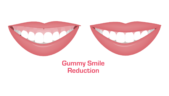 Animated smile before and after gummy smile reduction