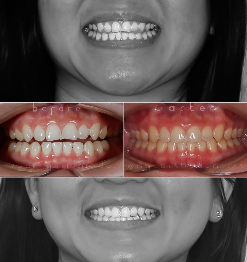 Patient's smile before and after treatment for overbite