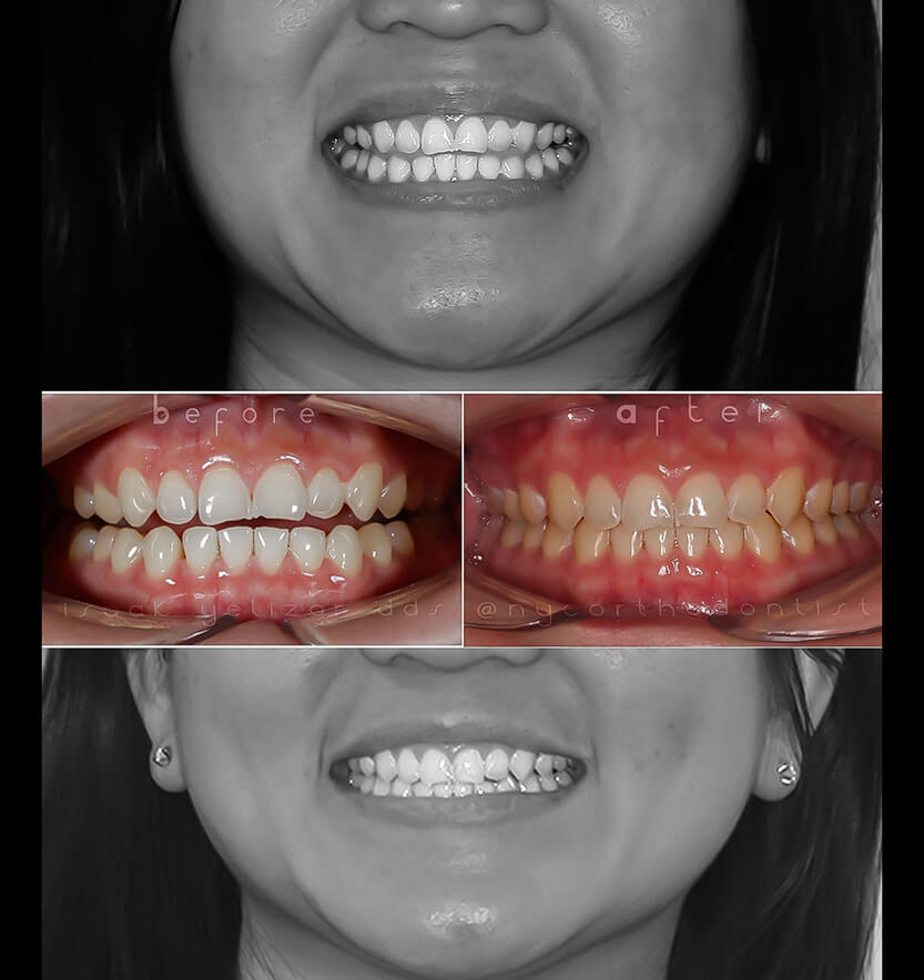 Patient's smile before and after treatment for overbite