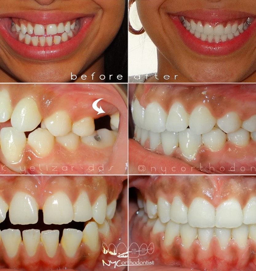 Smiel from front and side before and after overbite treatment