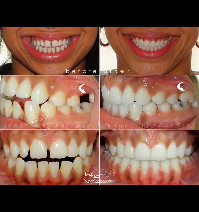 Smiel from front and side before and after overbite treatment