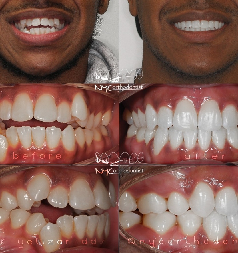 Patient's smile before and after overbite treatment