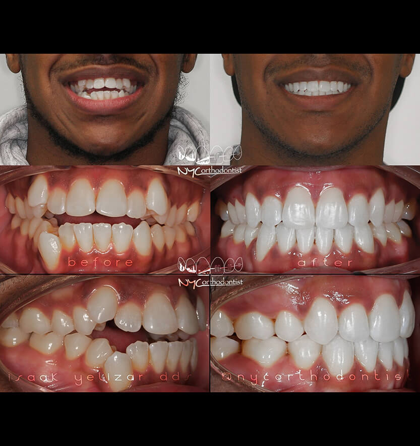 Patient's smile before and after overbite treatment
