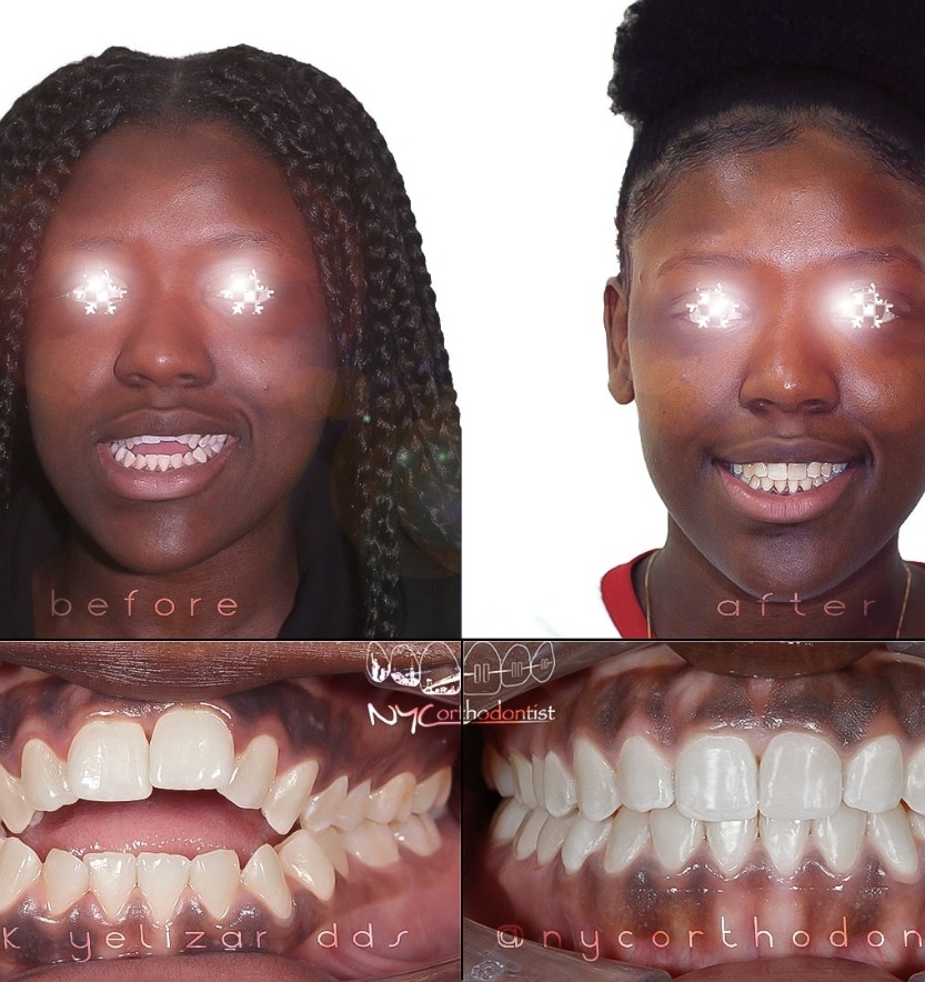 Patient before and after overbite treatment