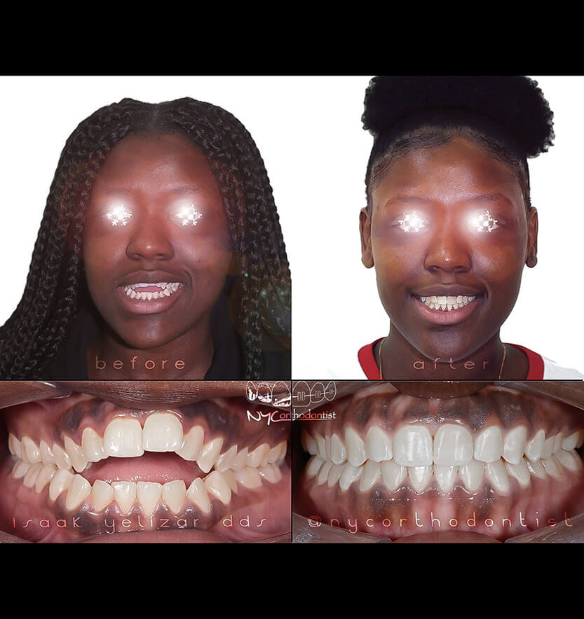 Patient before and after overbite treatment