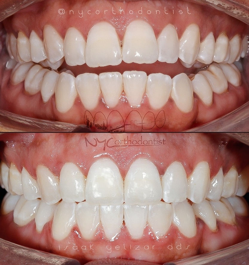 Closep of smile before and after overbite treatment