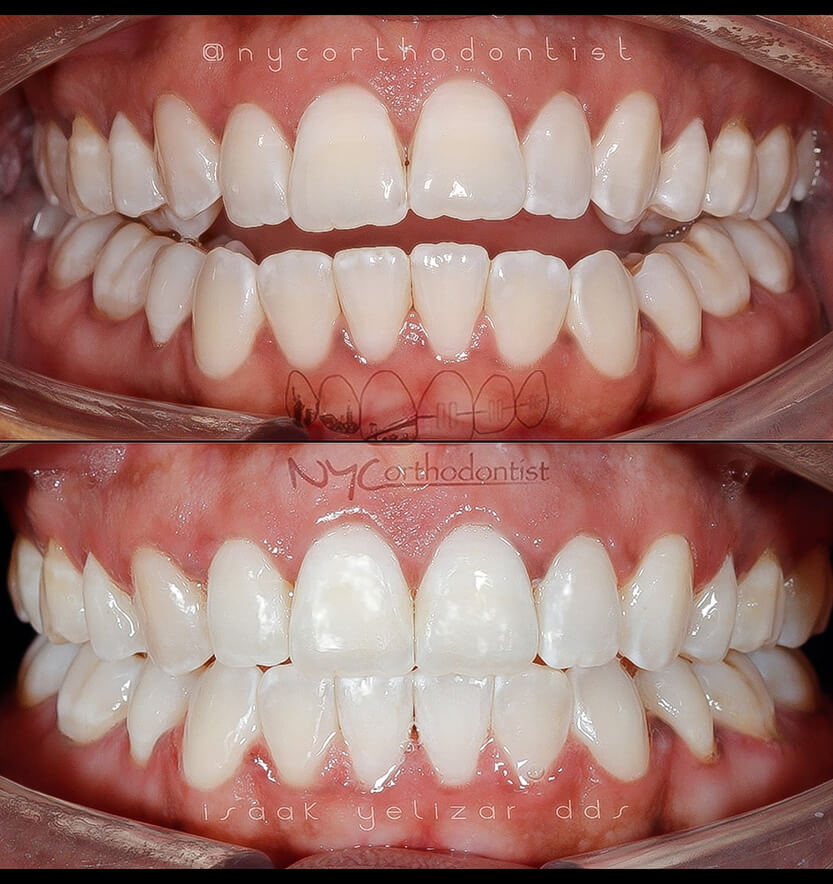 Closep of smile before and after overbite treatment