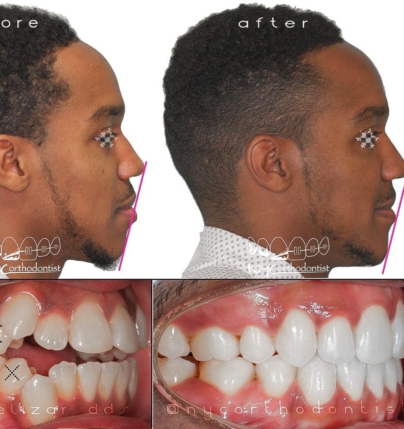 Patient's profile and smile before and after overbite treatment