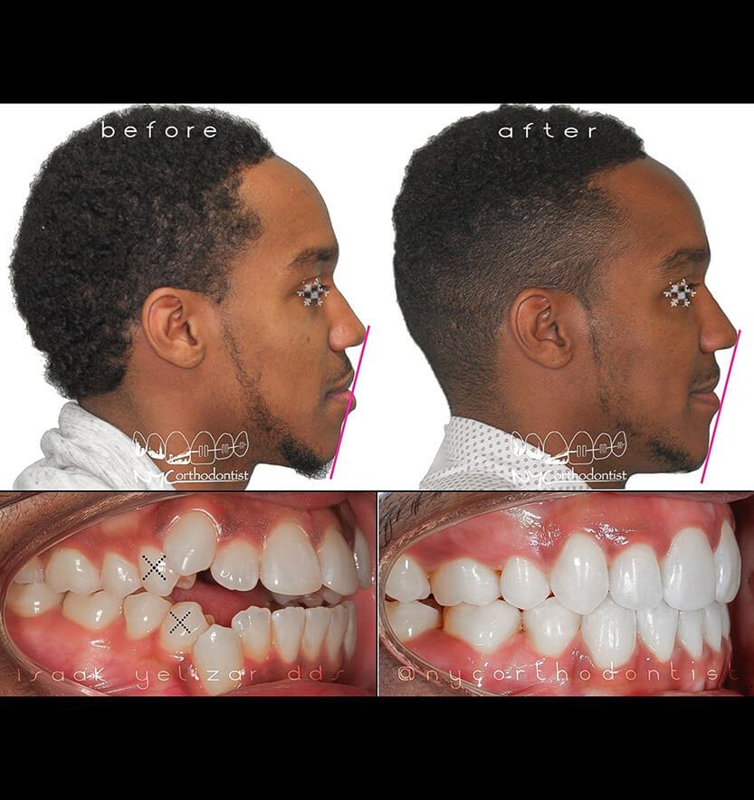 Patient's profile and smile before and after overbite treatment