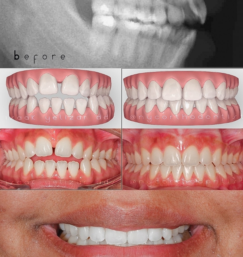 X-ray treatment animation and smile before and after treatment for overbite