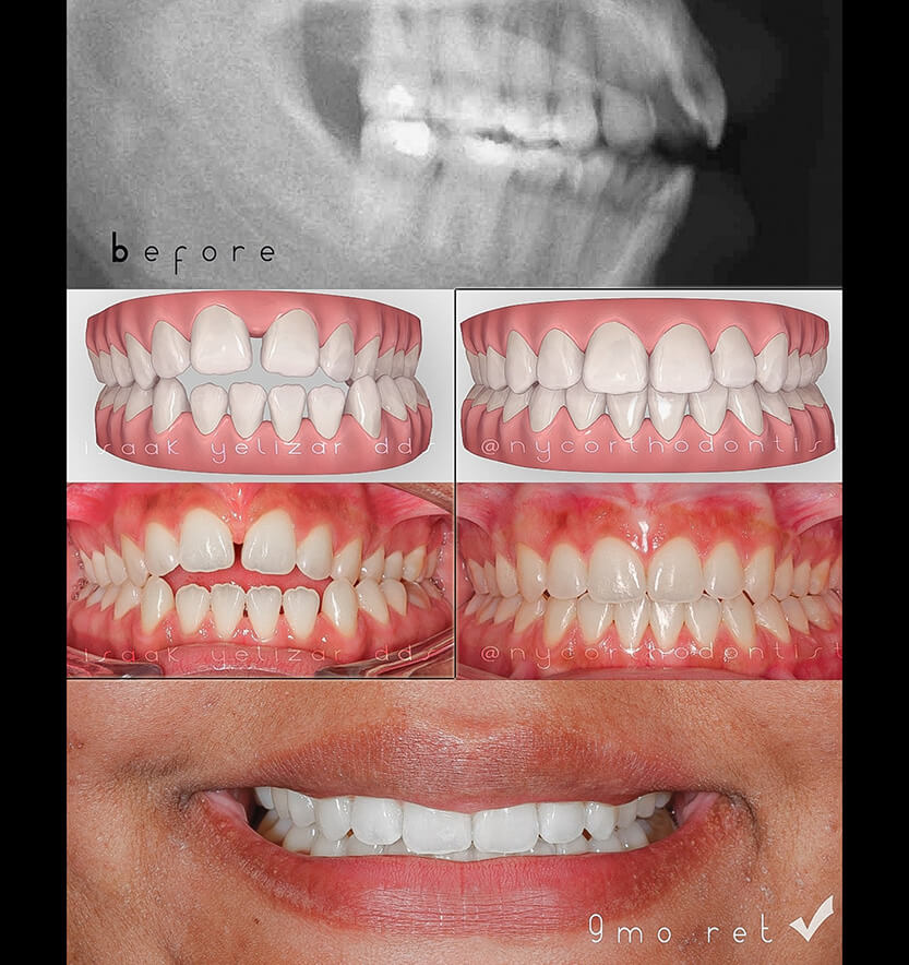 X-ray treatment animation and smile before and after treatment for overbite