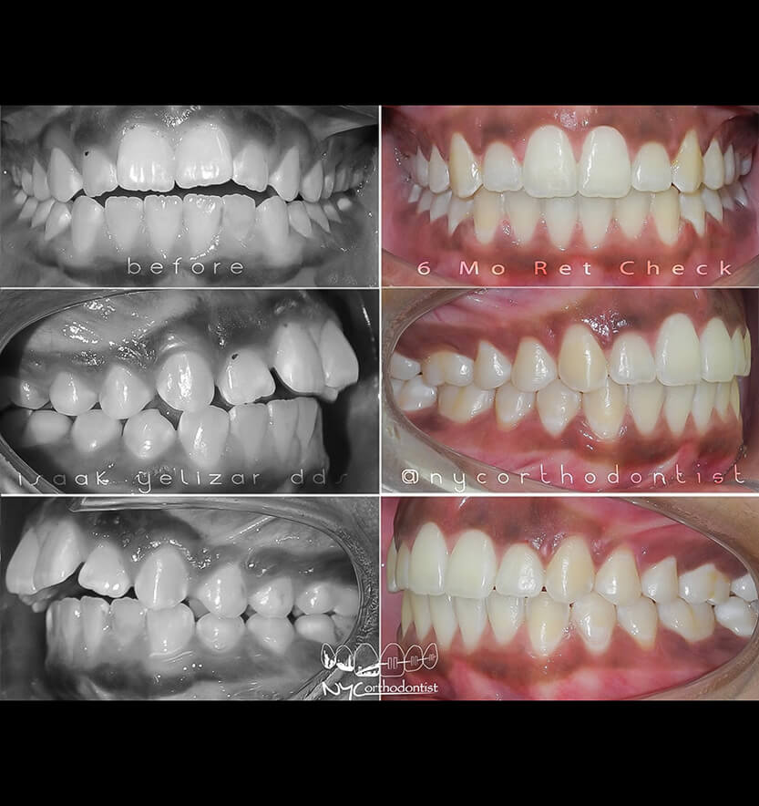 Front and side views of smile before and after treatment for overbite