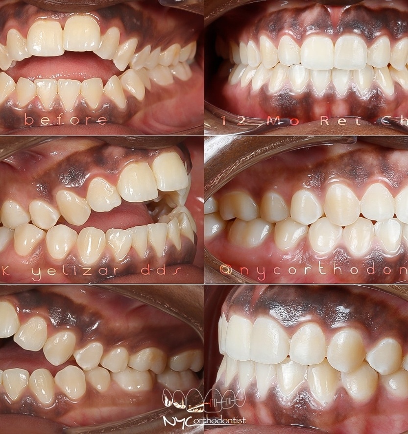 Front and side views of smile before and after treatment for severe overbite