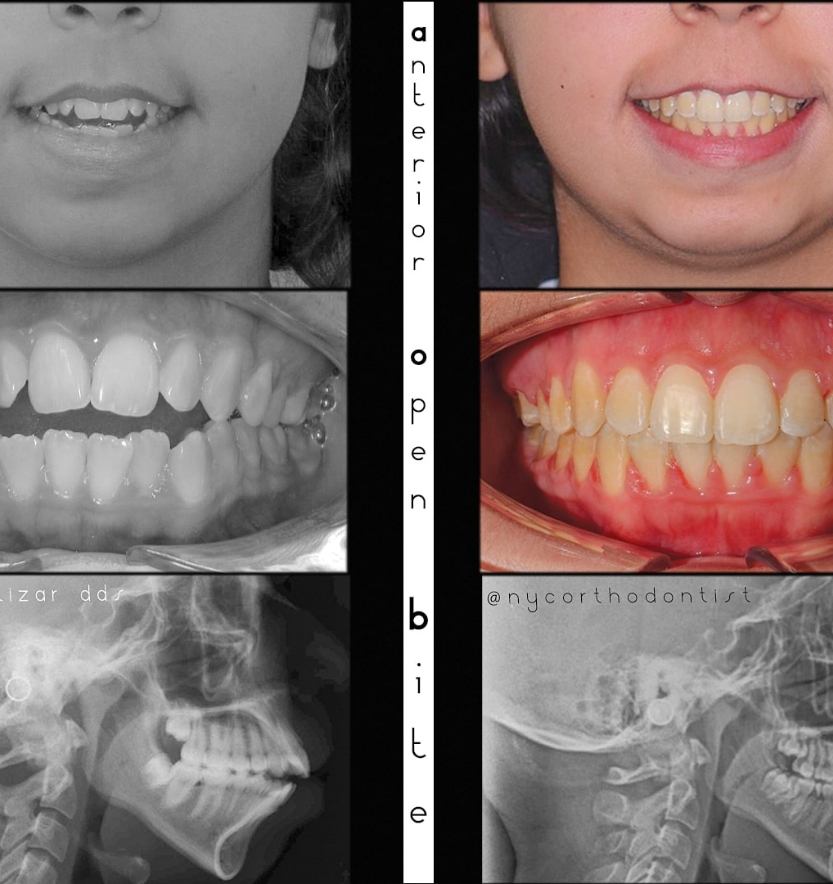 Patient's smile and x-rays before and after treatment for severe overbite
