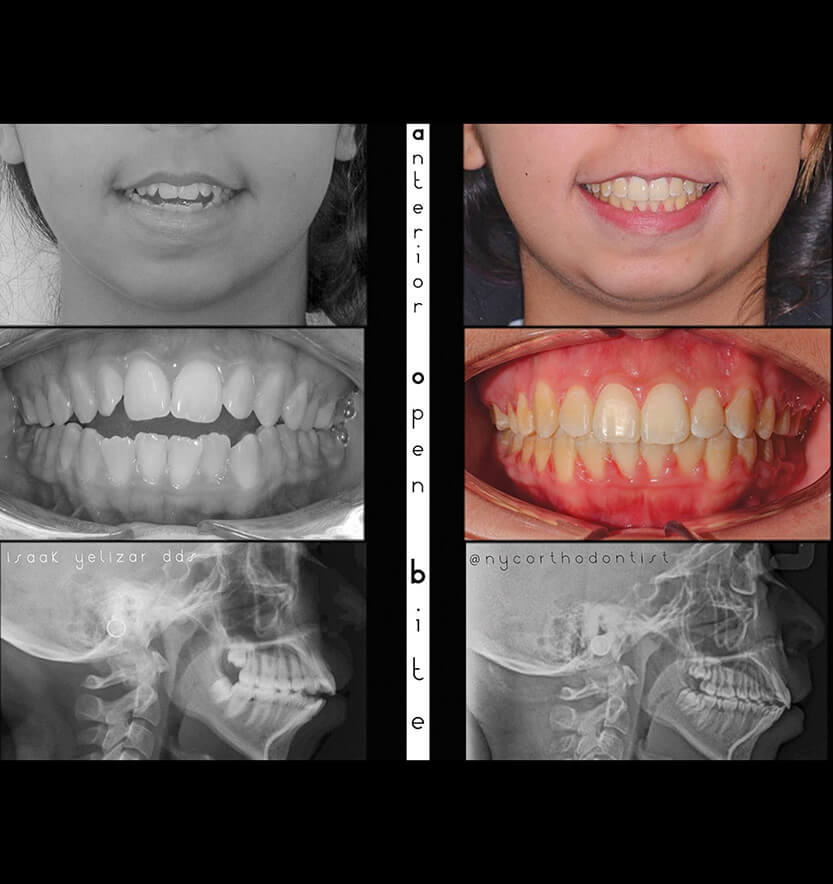Patient's smile and x-rays before and after treatment for severe overbite