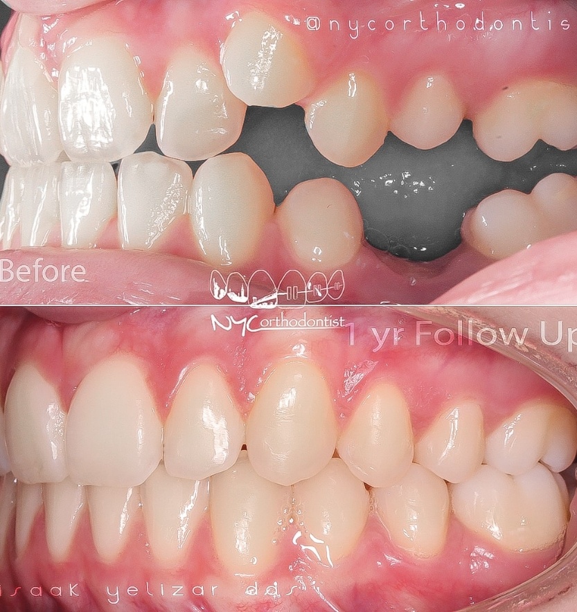 Side of smile before and after treatment for severe overbite