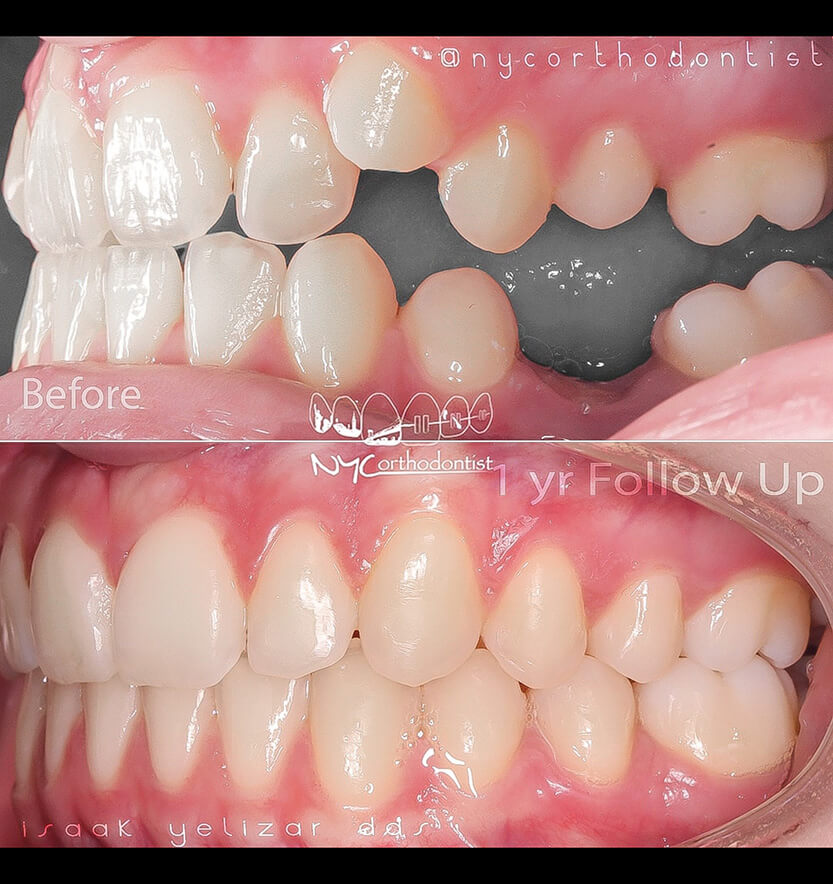 Side of smile before and after treatment for severe overbite