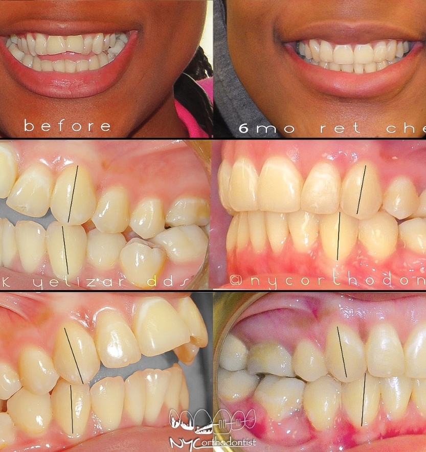 Patient's smile from the front and profice beofre and after overbite treatment