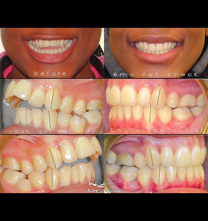 Patient's smile from the front and profice beofre and after overbite treatment