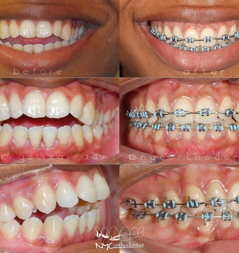 Patient's smile before during and after overbite treatment