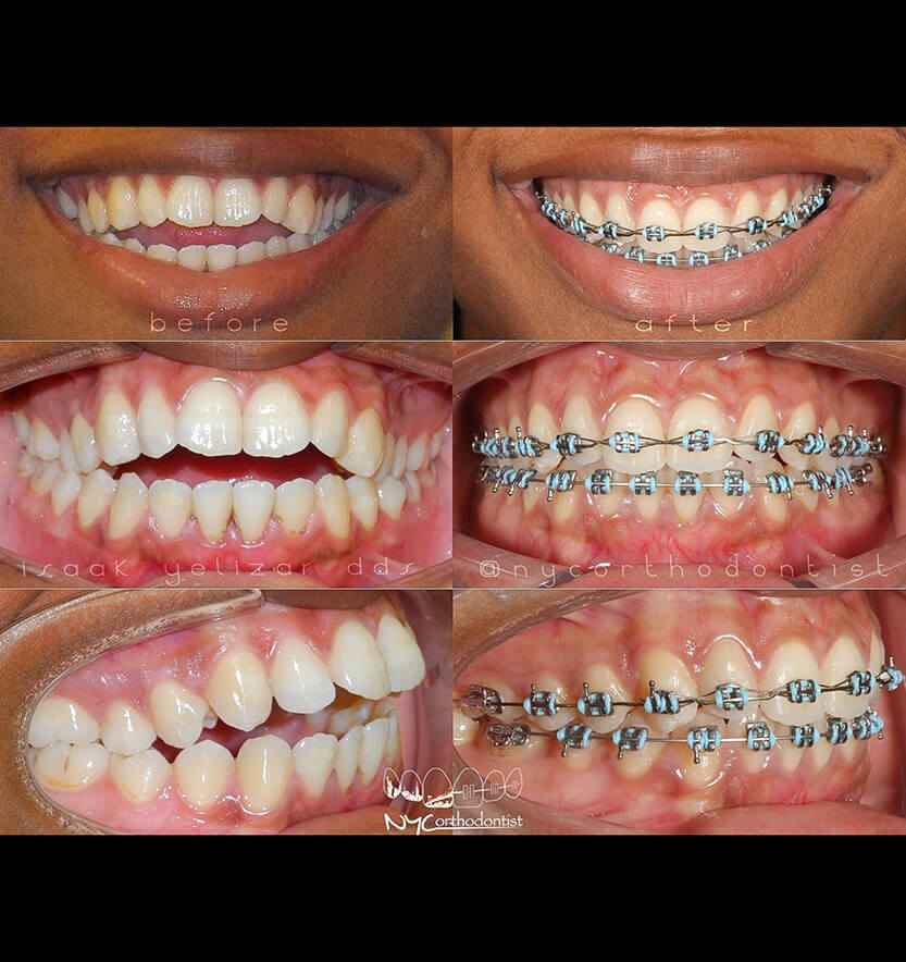 Patient's smile before during and after overbite treatment