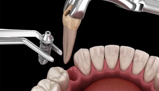 an example of an orthodontic extraction